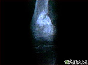 Osteogenic sarcoma - X-ray - Illustration Thumbnail              