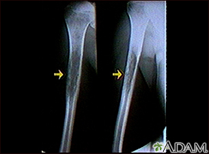 Ewing sarcoma - X-ray