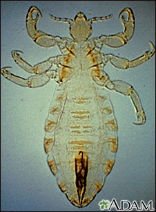 Body louse