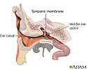 Ear tube insertion - Series