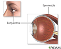 Eye muscle repair - series