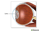 Cataract surgery - series