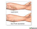right hand presentation -                          Scar revision - series