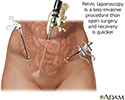 Pelvic laparoscopy