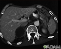 Adrenal metastases, CT scan