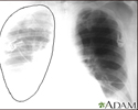 Aortic rupture, chest X-ray