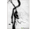 Carotid stenosis, X-ray of the right artery