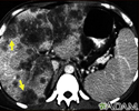 Hepatocellular cancer, CT scan