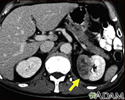 Kidney tumor - CT scan