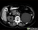 Kidney cyst with gallstones, CT scan