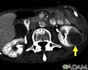 Kidney metastases, CT scan