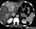 Liver with disproportional fattening, CT scan
