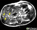 Melanoma of the liver -&#160;MRI scan