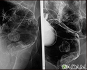 Rectal cancer, X-ray