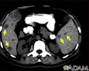 Spleen and liver metastases – CT scan