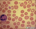 Red blood cells, spherocytosis