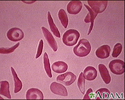 Red blood cells, multiple sickle cells