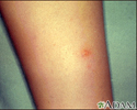 Chickenpox - lesion on the leg