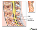 right hand presentation -                          Spinal bone graft - series