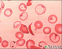 Red blood cells, sickle and pappenheimer
