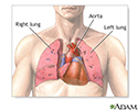 Heart-lung transplant  - series