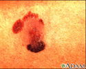 Skin cancer, malignant melanoma