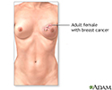 Breast reconstruction - series