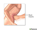 right hand presentation -                          Diagnostic peritoneal lavage - series