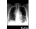 Sarcoid, stage IV - chest x-ray