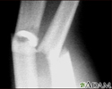 Fracture, forearm - X-ray