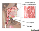 Candidal esophagitis