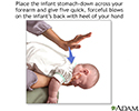 Choking first aid - infant under 1 year - series