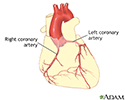 right hand presentation -                          Coronary artery balloon angioplasty - Series