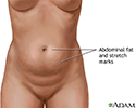 Abdominoplasty - series