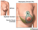 right hand presentation -                          Breast lift (mastopexy) - series - Incisions