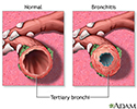 Bronchitis and Normal Condition in Tertiary Bronchus