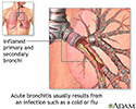 Cause of Acute Bronchitis