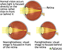 Normal, near, and farsightedness