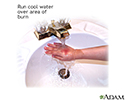 right hand presentation -                          Minor burn treatment - run under cool water