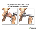 Torn hip joint repair