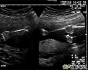 Ultrasonido, normal - brazos y piernas del feto