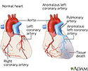 Anomalous left coronary artery