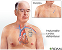 Implantable cardiac defibrillator