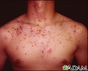 Acne, cystic on the chest