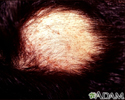 Alopecia areata with pustules