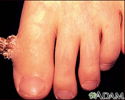 Wart (verruca) with a cutaneous horn on the toe