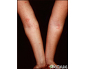 Dermatitis, atopic on the arms