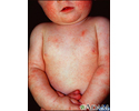 Dermatitis, atopic in an infant