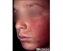 Dermatitis, contact on the cheek
