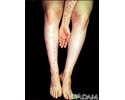 Dermatitis, herpetiformis on the arm and legs